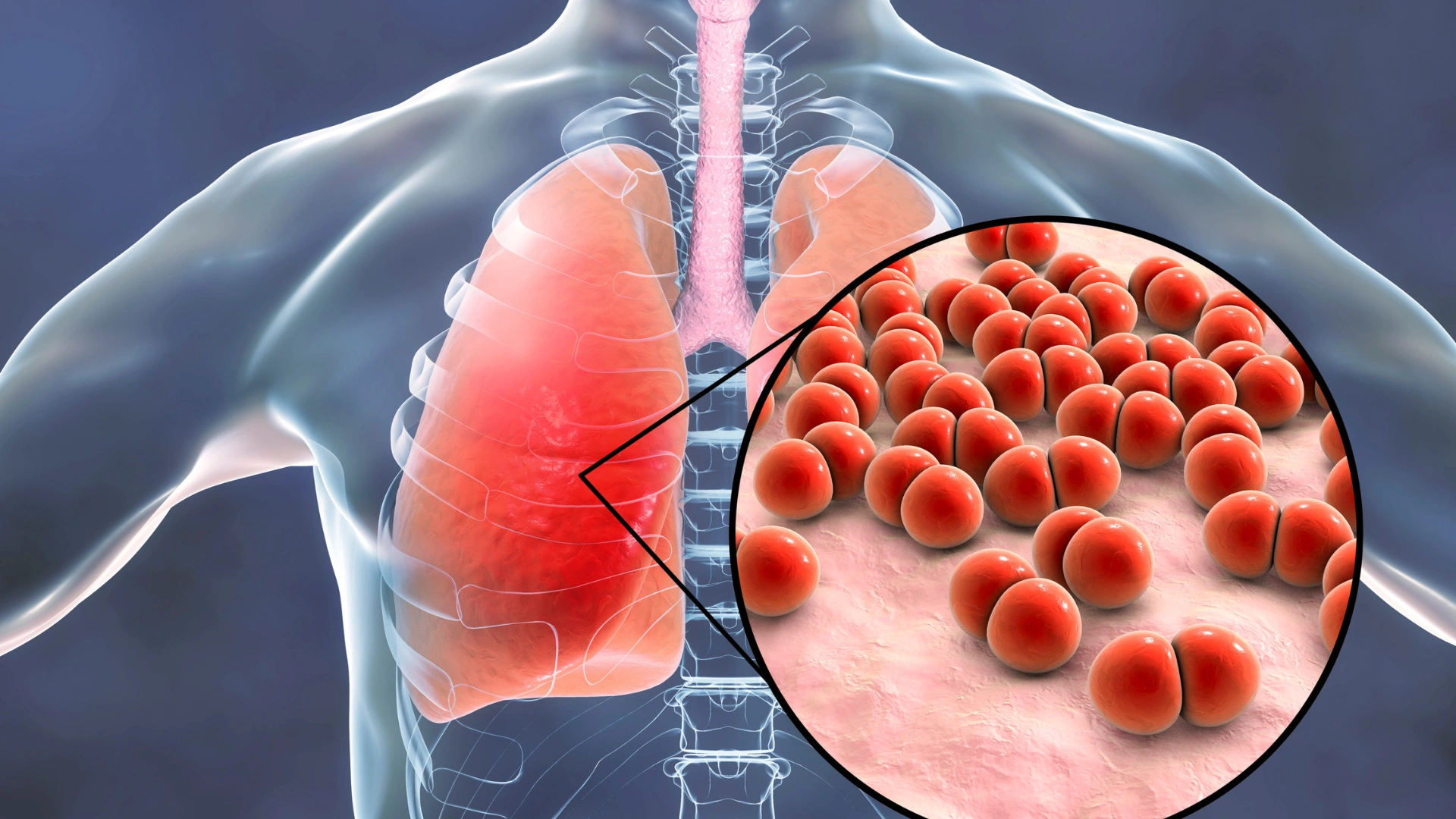 Telehealth for Pneumonia - DocToDoor Care